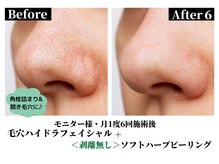 ハーシークレット(Her secret)/毛穴洗浄＋ハーブピーリング