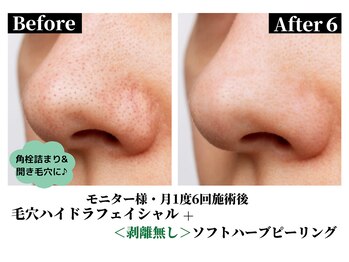 ハーシークレット(Her secret)/毛穴洗浄＋ハーブピーリング