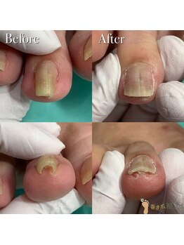 仙台巻き爪補正店/【巻き爪補正】