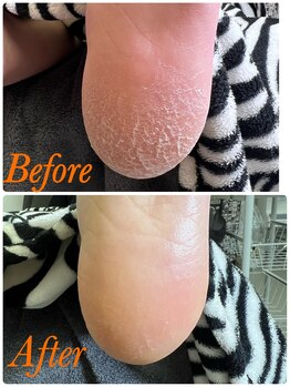 リゼラアンドコー 茂原店/かかとのガサガサケアできます