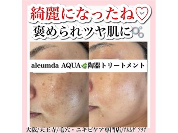 アルムダアクア 天王寺店(Aleumda AQUA)/ハーブピーリング/大阪/天王寺