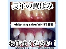 ホワイトニングサロン ホワイト(WHITE)/セルフホワイトニング/大阪/福島