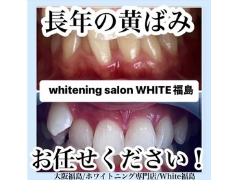 ホワイトニングサロン ホワイト(WHITE)/セルフホワイトニング/大阪/福島