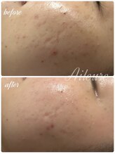 エルール トータルビューティ(Aileure total beauty)/肌質改善ララピール