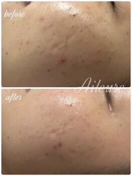 エルール トータルビューティ(Aileure total beauty)/肌質改善ララピール