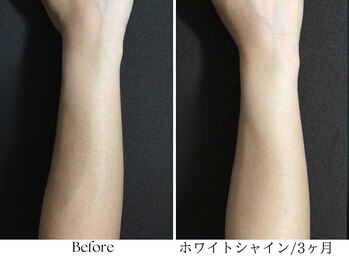 ビボーラ(BEBEAURA)/ホワイトシャイン