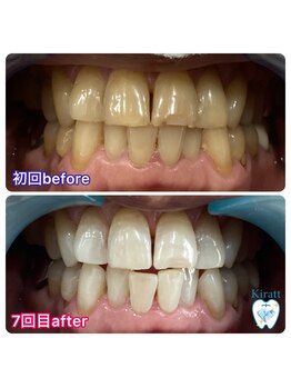 キラット 札幌中島公園店(Kiratt)/60代男性リピーター様