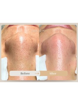 毛穴ケアをしたい