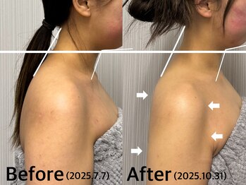 ベール(BEHL)/コルギのBeforeAfter