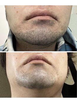 メンズ脱毛＆ヘッドスパ MEN'S with Lilina. 新横浜［ヒゲ脱毛/全身脱毛/VIO脱毛］/ヒゲ脱毛8回　最新LEDメンズ脱毛