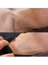 プライベートサロン プース(pousse)/首イボケア