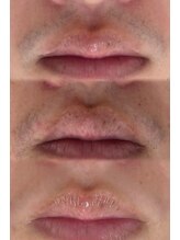 アトリーチェ ベレッツァ(ATTRICE Bellezza)/ヒゲ脱毛