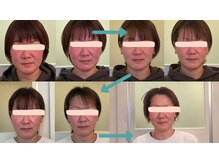 ホルバールウェルネス(Hallbar Wellness)/期待を裏切らない光糸リフト！