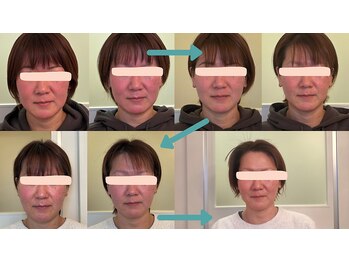 ホルバールウェルネス(Hallbar Wellness)/期待を裏切らない光糸リフト！