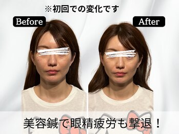 ハリユナイテッド 原宿鍼灸 整体院(HALI UNITED)/小顔+眼精疲労にも◎