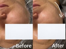 ベール(BEHL)/ジェリーマスクのBeforeAfter