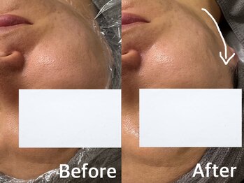 ベール(BEHL)/ジェリーマスクのBeforeAfter