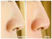 ラミーユ(La Miu)/1度の施術で毛穴汚れが改善