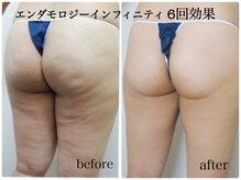 フェムプリュ(femplus)の雰囲気（セルライトが消える！！エンダモロジーインフィニティで叶えます）
