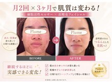 プルーム(Plume)/3ヶ月の肌育成結果（毛穴ケア）