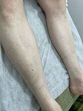 ナノハナ/鹿沼市の全身脱毛のナノハナ