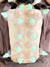 スピロソフィア/背中のカッピング