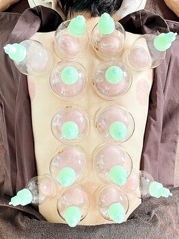 スピロソフィア/背中のカッピング