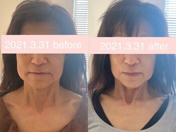 サクラ 伊勢原店(SAKURA)/艶キメ・くすみ・ほうれい線改善