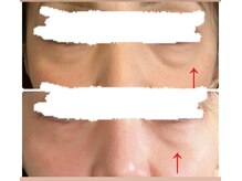 エスポワール(espoir)/目元脂肪、たるみ改善症例