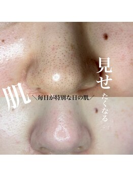 アーフ(ARF)/肌質改善