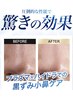【ニキビケア＋毛穴改善強化月間！】プラズマ&毛穴洗浄¥13,200→¥8,800