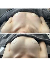 モア(moa)/左右差