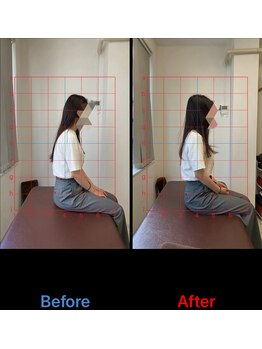 とるこり美姿整体院 新宿院/ 20代女性-姿勢矯正 2ヶ月経過