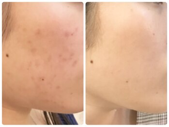 ラウン 京都(ROUN')/約半年の施術ビフォーアフター