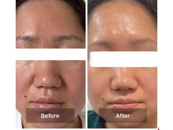 モカ 天王寺店(MOKA)/毛穴の黒ずみ　毛穴ポツポツ