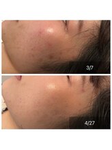 アウル 鳳店(OWL)/美容鍼ビフォーアフター