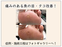 巻き爪補正店 大分店の雰囲気（痛みのある魚の目も！症例・施術工程はフォトギャラリーへ♪）