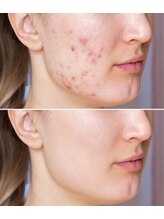 ナチュレアンドメディカ(Nature&Medica)&nbsp;ニキビケア 東京都町田