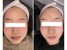 [平日限定]9時半～13時最強小顔コース＋ヘッドスパ
