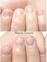 マリーロール 天王寺店(Marie Laure)/自爪育成/深爪矯正/ネイルケア