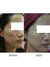 アップルミント/＜フェイシャル＞before・after