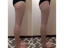 クリニカルエステ/イーズ 六甲アイランド店/【レモンボトル】下半身太り解消