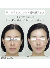 江原道 銀座サロン(Koh Gen Do)/リフトアップ、ツヤ・透明感UP