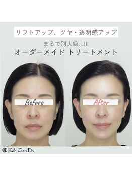 江原道 銀座サロン(Koh Gen Do)/リフトアップ、ツヤ・透明感UP