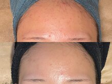 ゾーンビューティーハウス 柏店(ZONE BEAUTY HOUSE)/☆小さなぷつぷつサヨウナラ☆