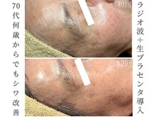 シストワ(sistoi)の雰囲気（W効果でハリ弾力の元、コラーゲンが増えて自然なエイジングケア）