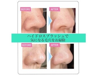 アイコ 岡山東店(eyeco)/毛穴ケア