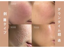 アルフォービューティー 難波店(ALU for beauty)/ローズドメーラ症例