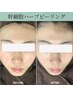 【人気NO.1】最強肌質改善◎幹細胞ハーブピーリング　￥27,500→￥9,600