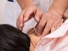 Q.頭痛って鍼灸でも良くなるの？→A.もちろん！実際に痛みが和らいだ方多数！